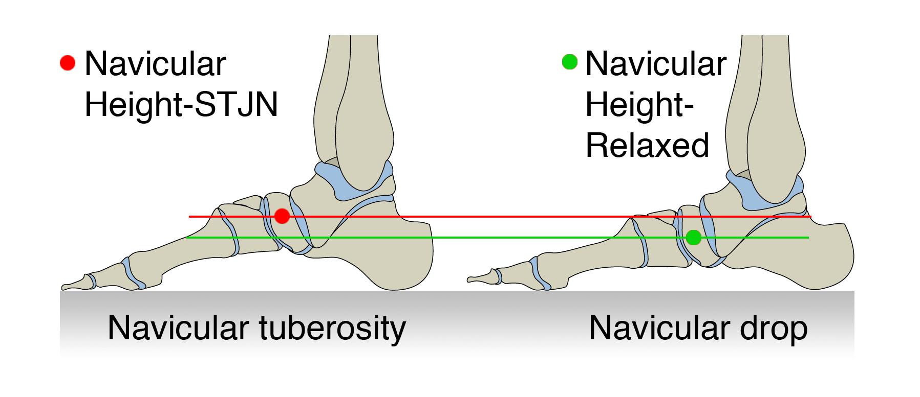 Figure 2: Navicular drop