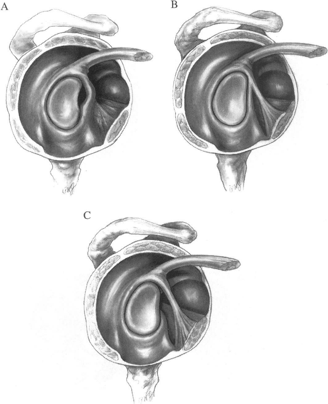 Normal anatomic variants of the anterosuperior glenoid labrum and glenohumeral ligaments. A = Sublabral foramen; B = Cord-like middle glenohumeral ligament; C = Buford complex (cordlike middle glenohumeral ligament with absence of anteriorsuperior labral tissue). From Alessandro et al 2000