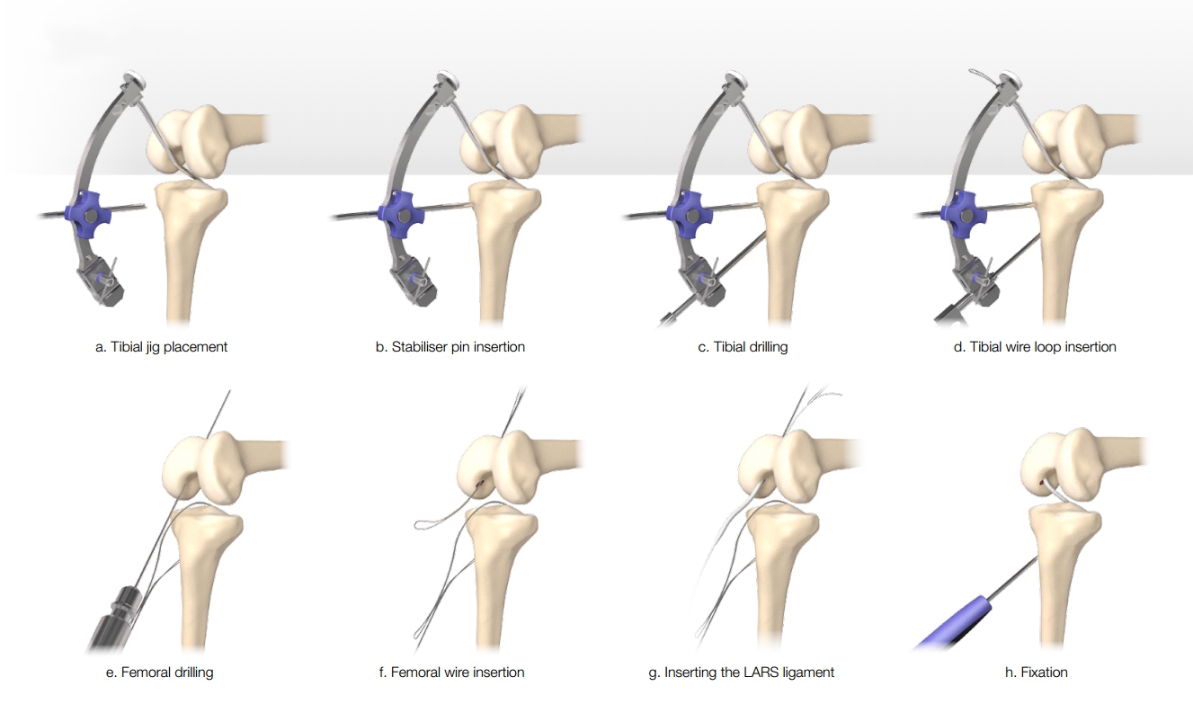 Figure 2: Summary of LARS operative procedure*