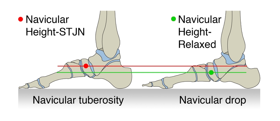 Prevention and Treatment of Shin Splints