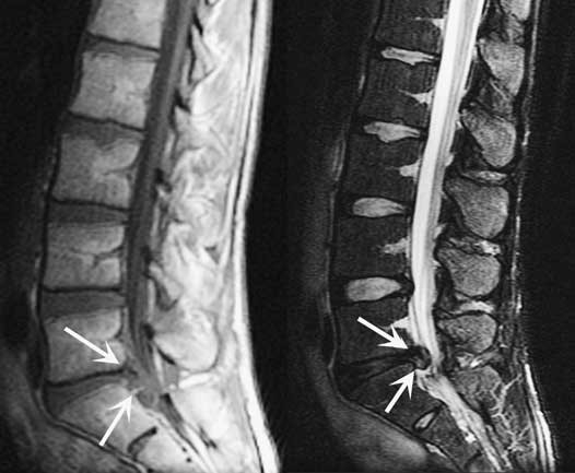 Image on left is a sagittal T1 weighted image; image on right is a sagittal weighted T2 image