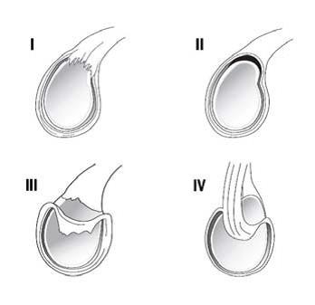 Type I represents a frayed or degenerative labrum with attachment of the labrum to the glenoid. Type II represents detachment of the superior labrum and biceps from the glenoid rim. Type III represents a bucket-handle tear of the labrum with an intact biceps anchor. Finally, type IV represents a bucket handle tear of the labrum that extends into the biceps tendon. (From Dodson and Altchek 2009)